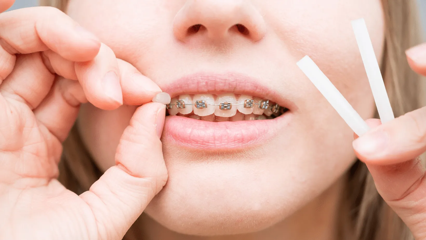 Curiozități despre ceara ortodontică și eficacitatea ei