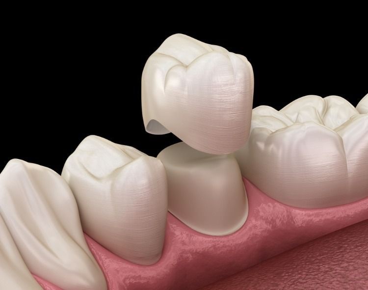 Coroana dentara ceramica pe suport zirconiu